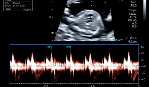 Cidade do RS propõe que vítimas de estupro ouçam coração do feto antes de abortar