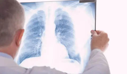 Câncer de pulmão: novo medicamento impede progressão em 60% dos pacientes